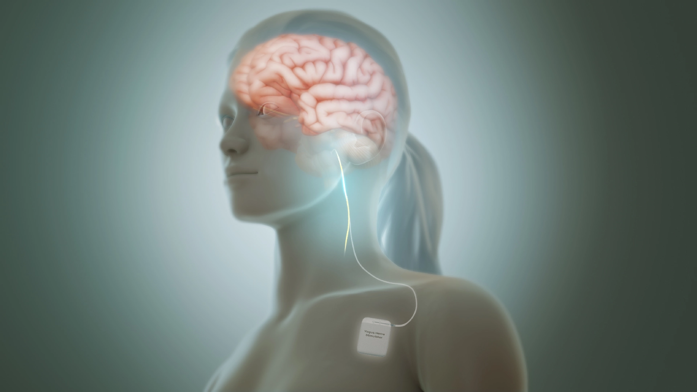 Vagus Nerve Stimulation in Difficult-to-Treat Depression: When Does It Work Best?